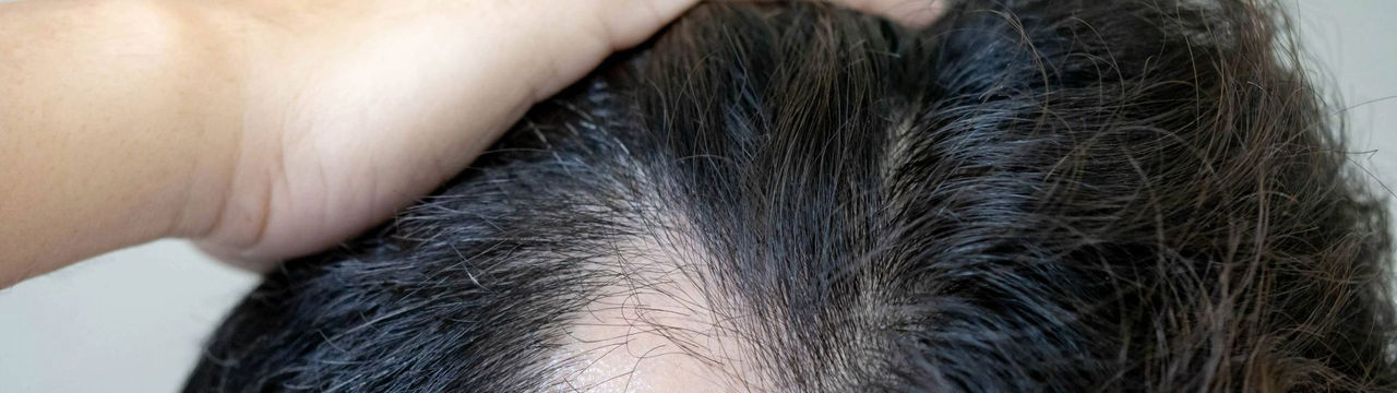 Verursacht Intervallfasten Haarausfall?