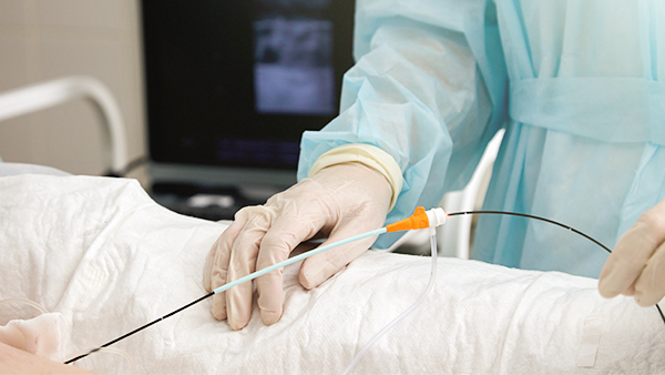 Katheterablation bei Herzrhythmusstörungen