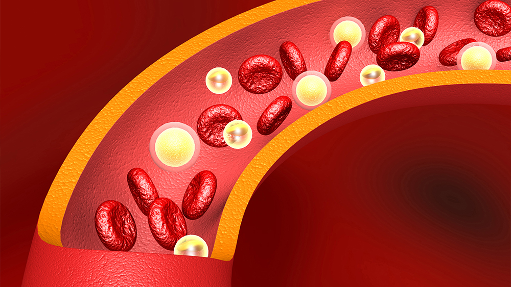 Familiäre Hypercholesterinämie: Ursache und Symptome