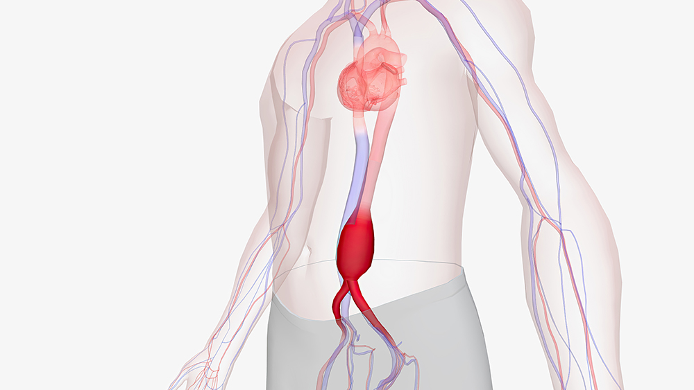 Aortenaneurysma: Definition und Behandlung
